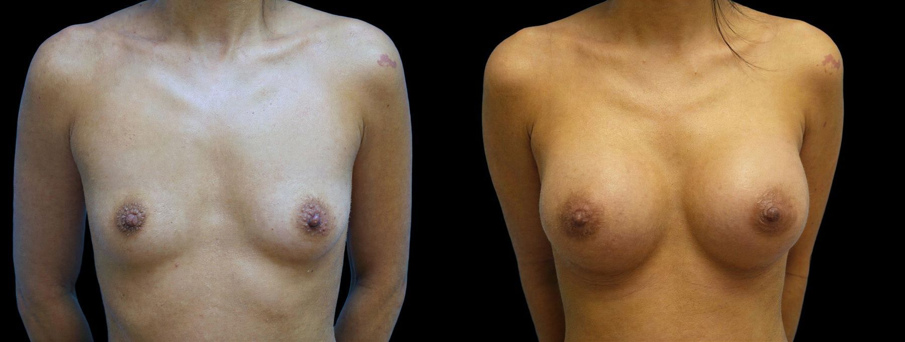 Before and after Breast Augmentation case 42945