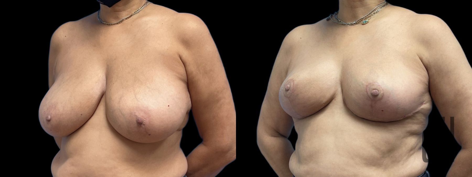 Before and after Breast Reduction case 41235 - Angle 2