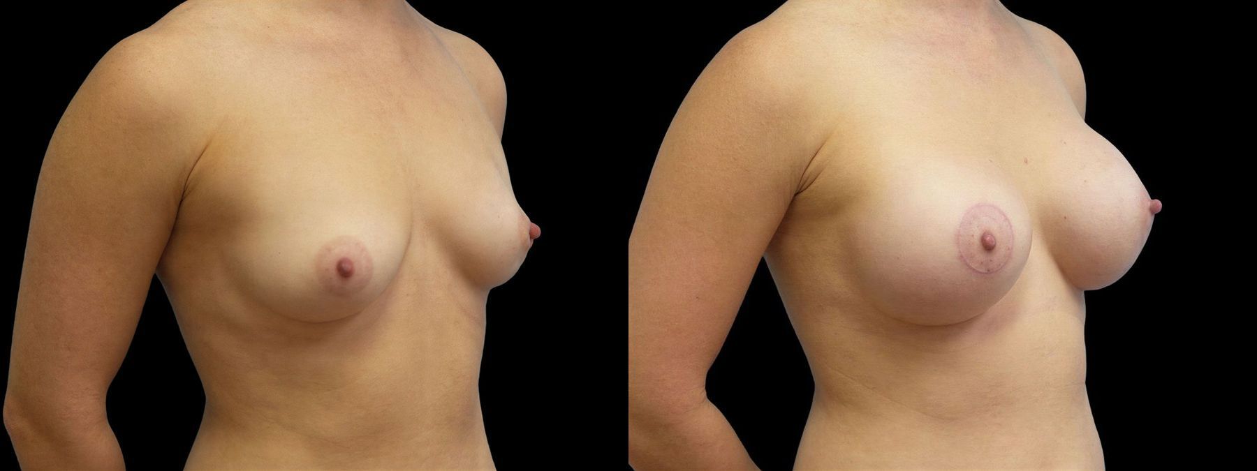 Before and after Breast Augmentation with Lift case 42942 - Angle 2