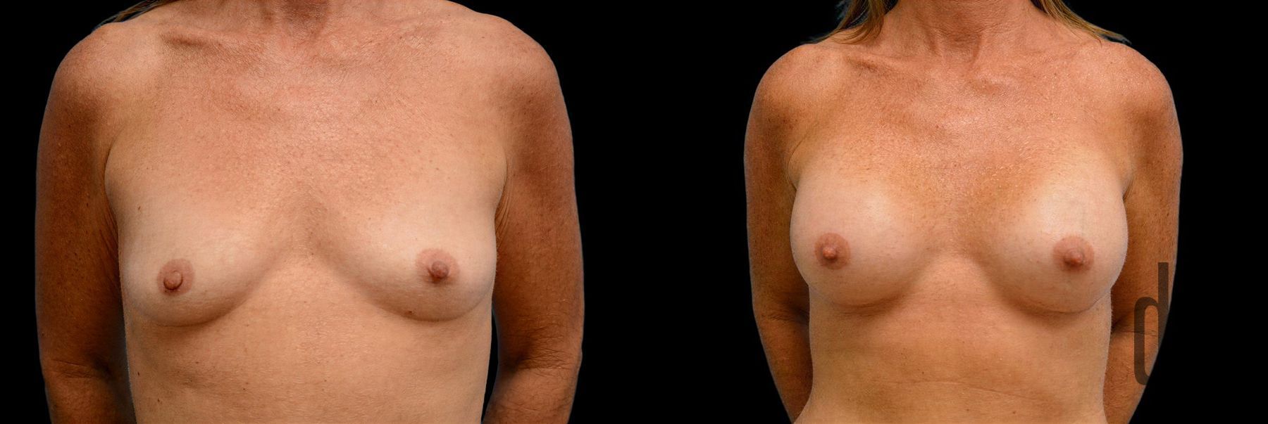 Before and after Breast Augmentation case 42818