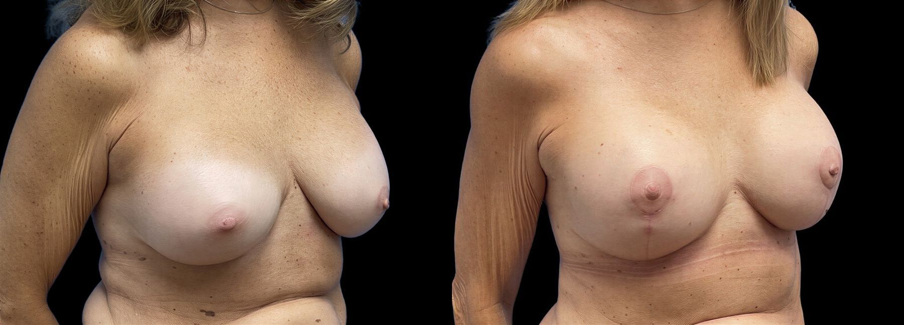 Before and after Implant Replacement Mastopexy case 43152 - Angle 2