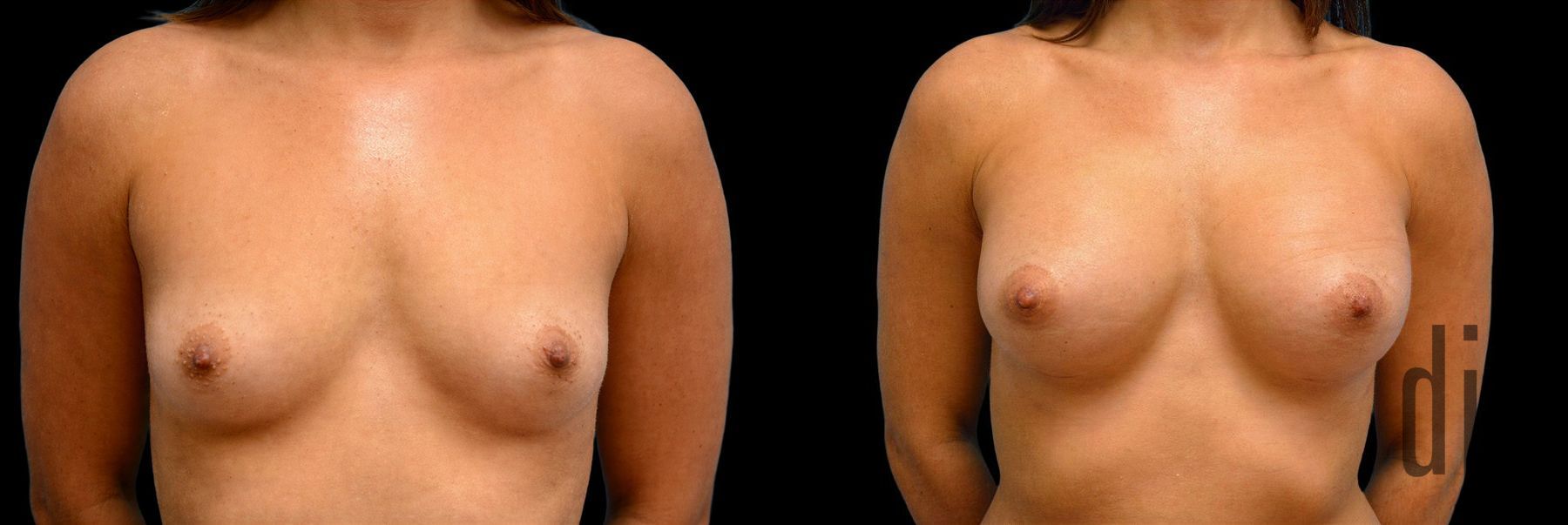 Before and after Breast Augmentation case 42801