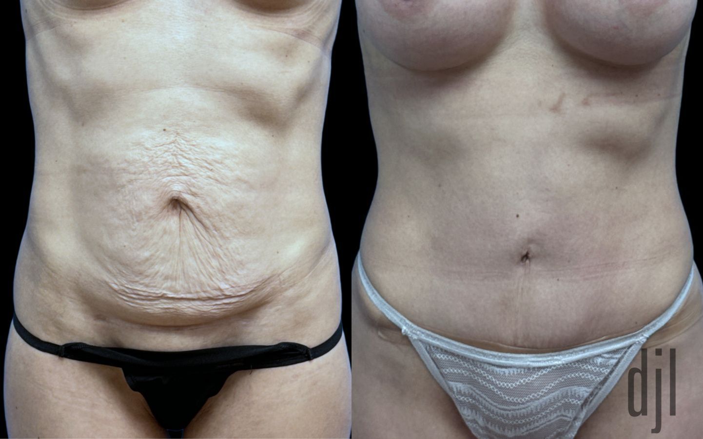 Before and after Tummy Tuck case 41351