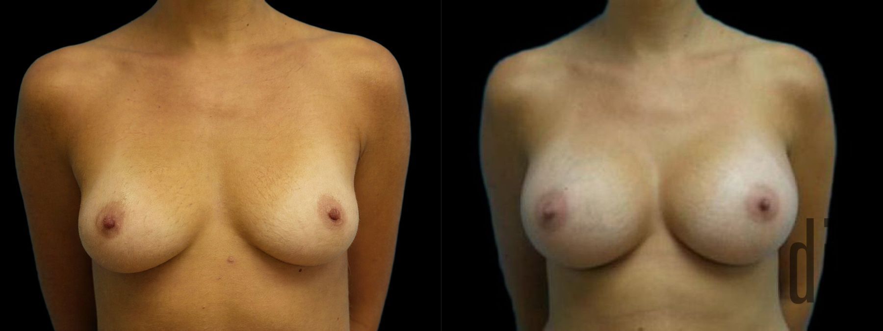Before and after Breast Augmentation case 42943
