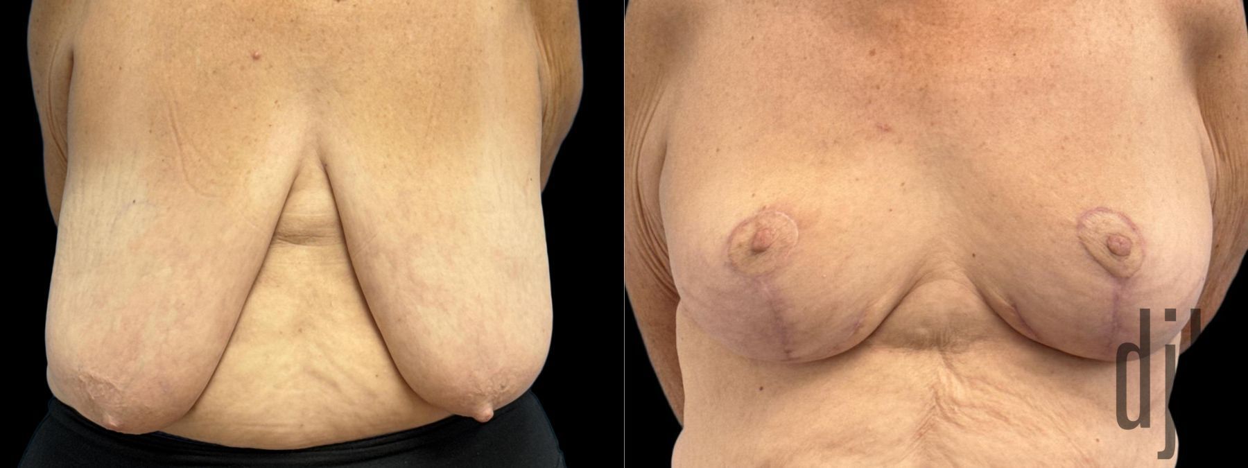 Before and after Breast Reduction case 33061