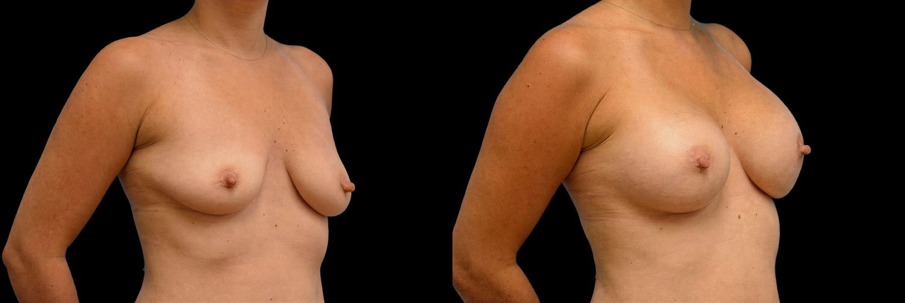 Before and after Breast Augmentation case 42892 - Angle 2