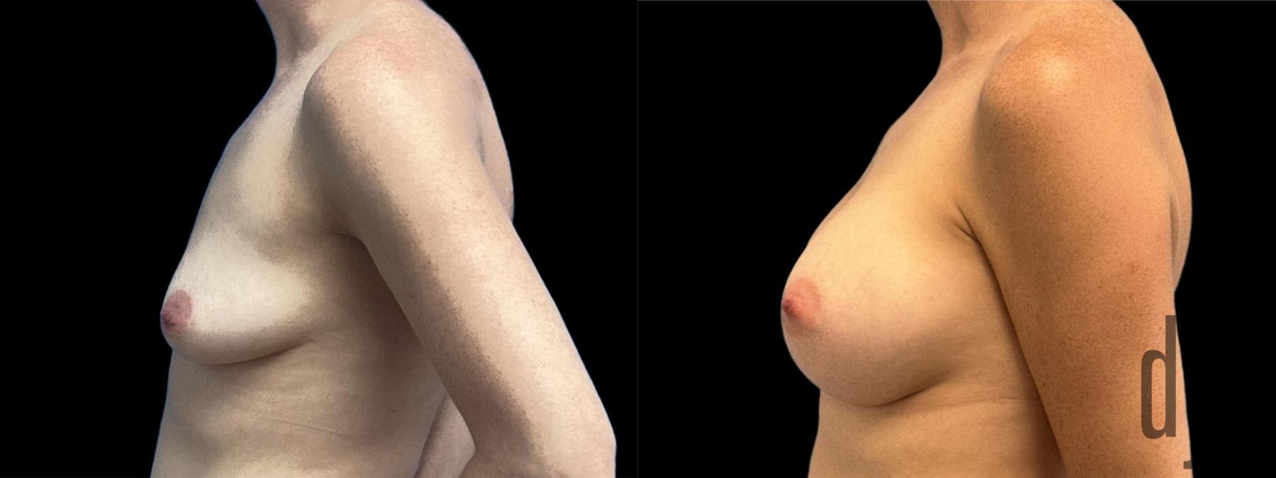 Before and after Breast Augmentation case 33057 - Angle 2
