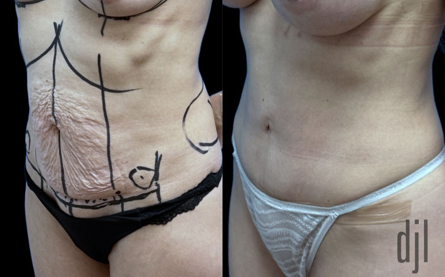 Before and after Tummy Tuck case 41351 - Angle 2