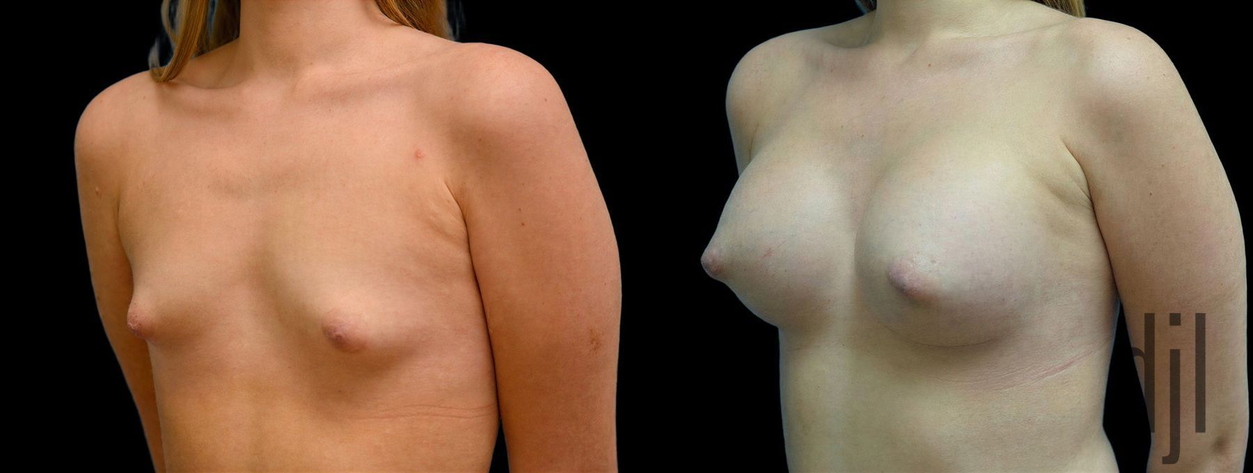 Before and after Breast Augmentation case 42906 - Angle 2