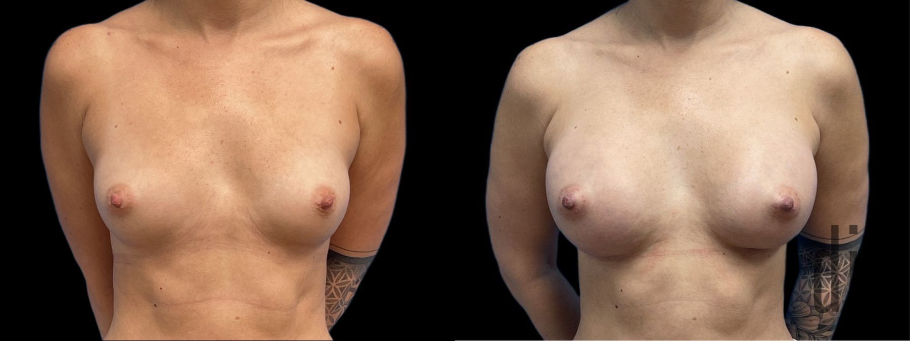Before and after Breast Augmentation case 37381