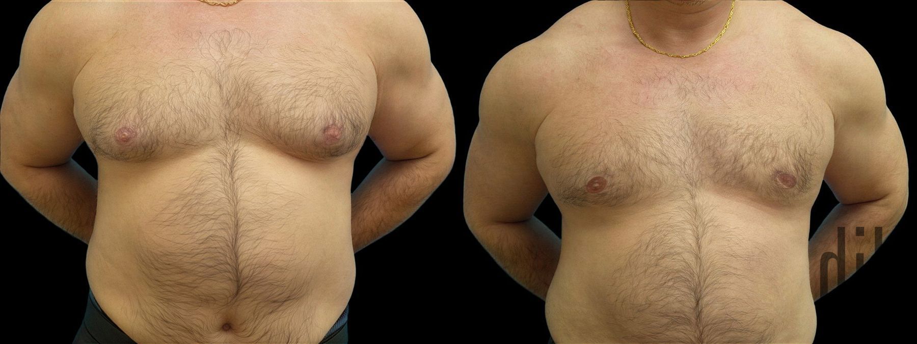 Before and after Gynecomastia case 42824