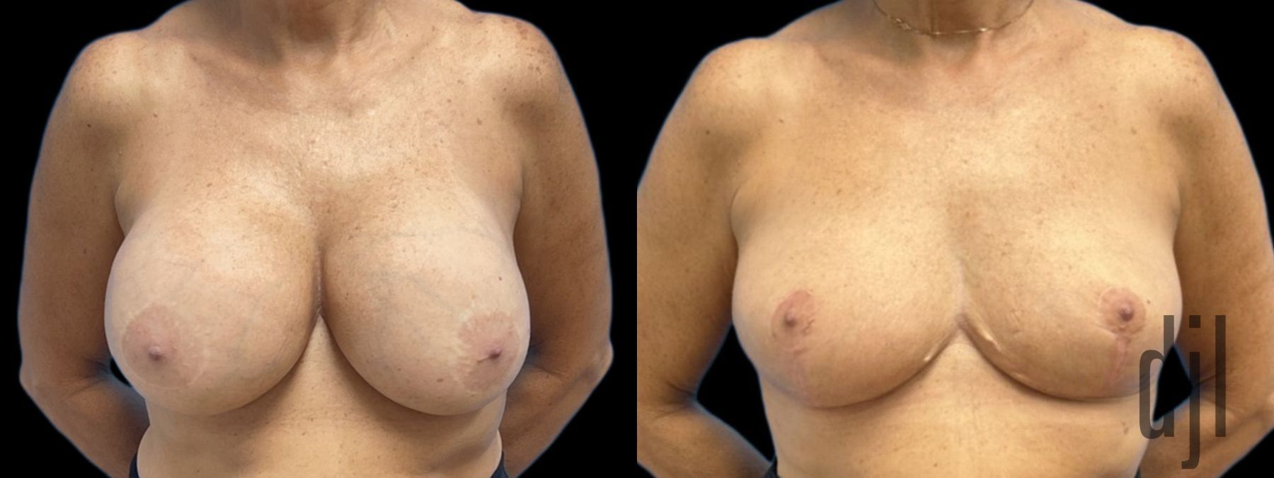 Before and after Explant Mastopexy case 37385