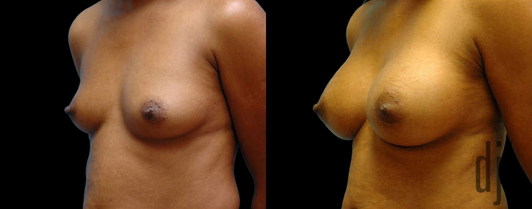 Before and after Breast Augmentation case 42644 - Angle 2