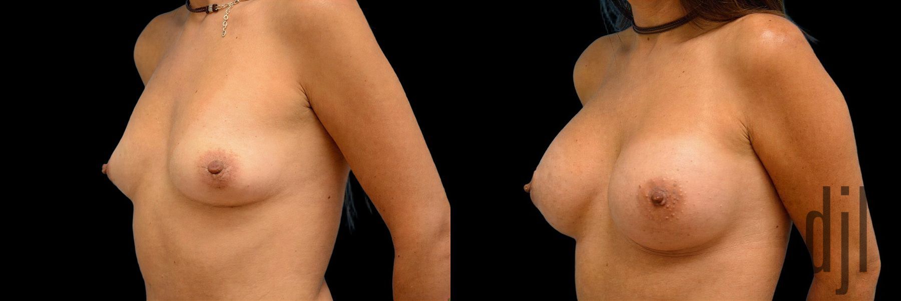 Before and after Breast Augmentation case 42829 - Angle 2