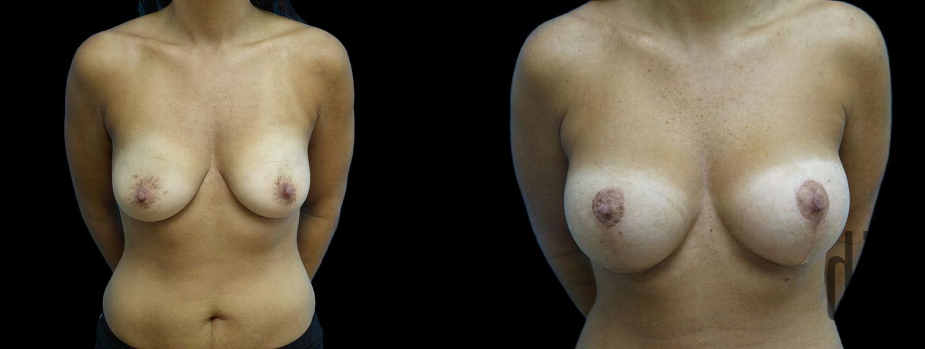 Before and after Breast Augmentation with Lift case 42802