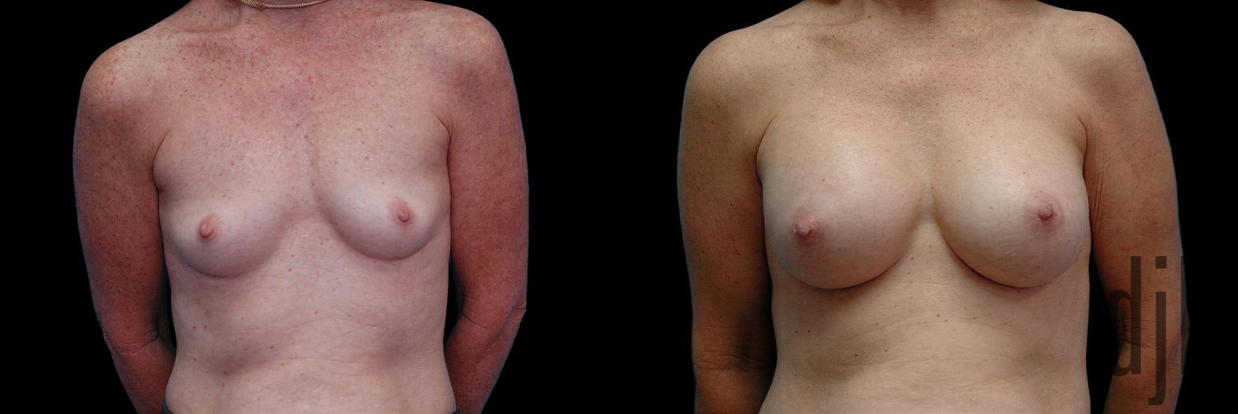 Before and after Breast Augmentation case 42706