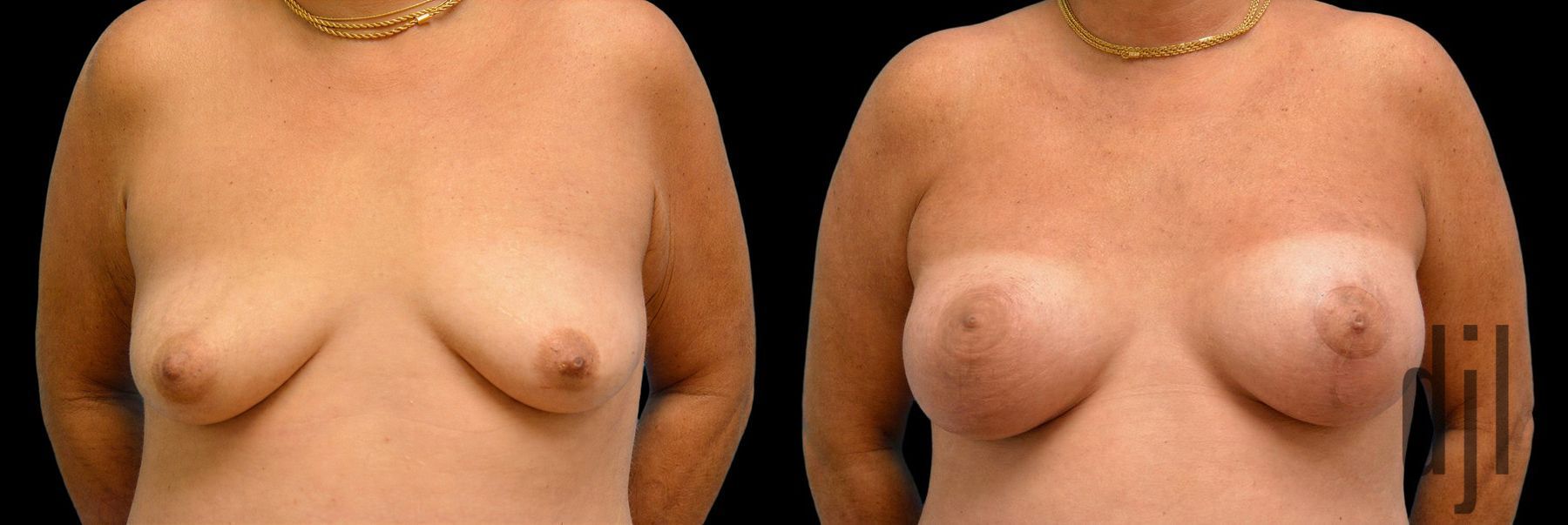 Before and after Breast Augmentation with Lift case 42781