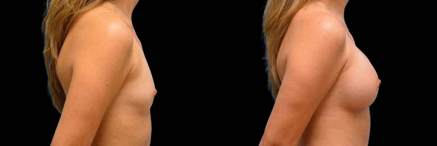 Before and after Breast Augmentation case 42843 - Angle 2