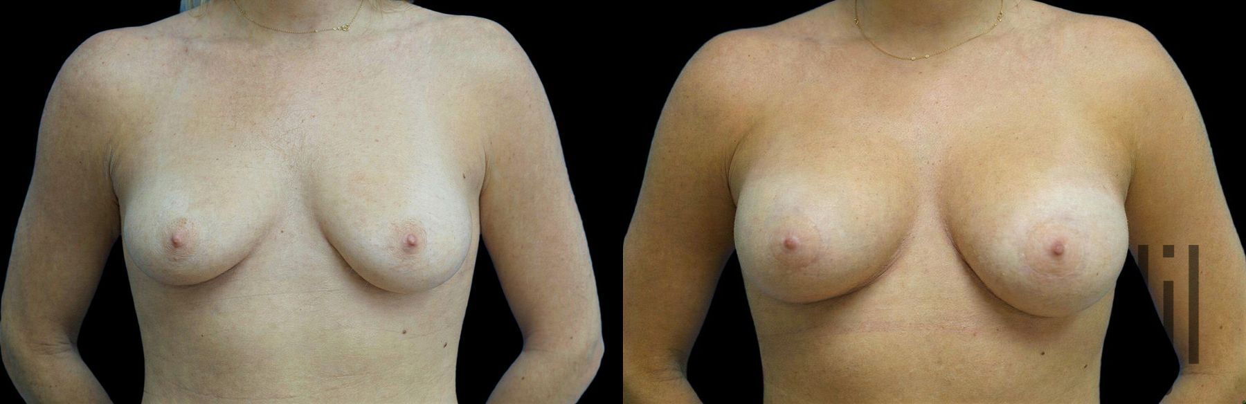 Before and after Breast Augmentation case 42932