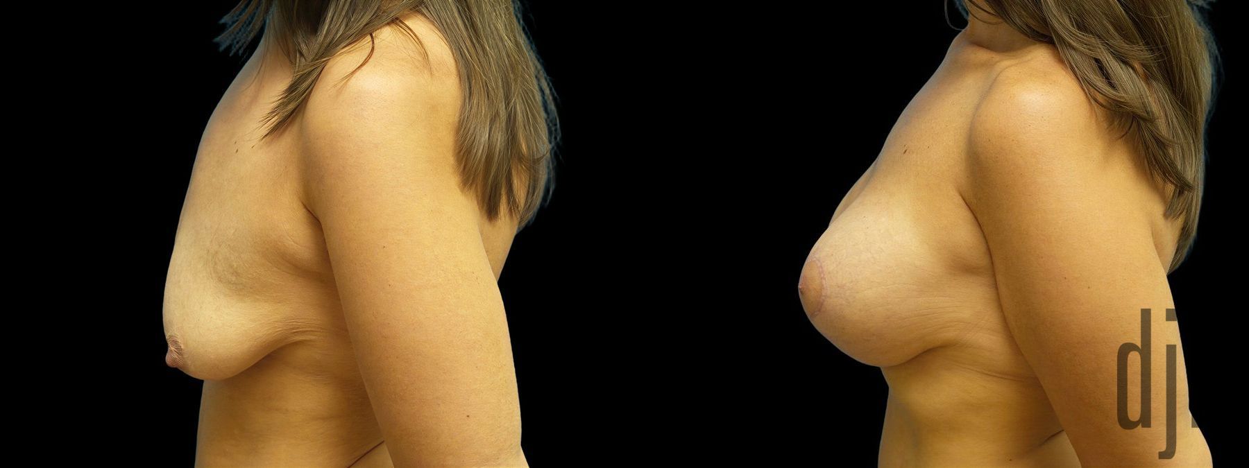 Before and after Breast Augmentation with Lift case 42894 - Angle 2