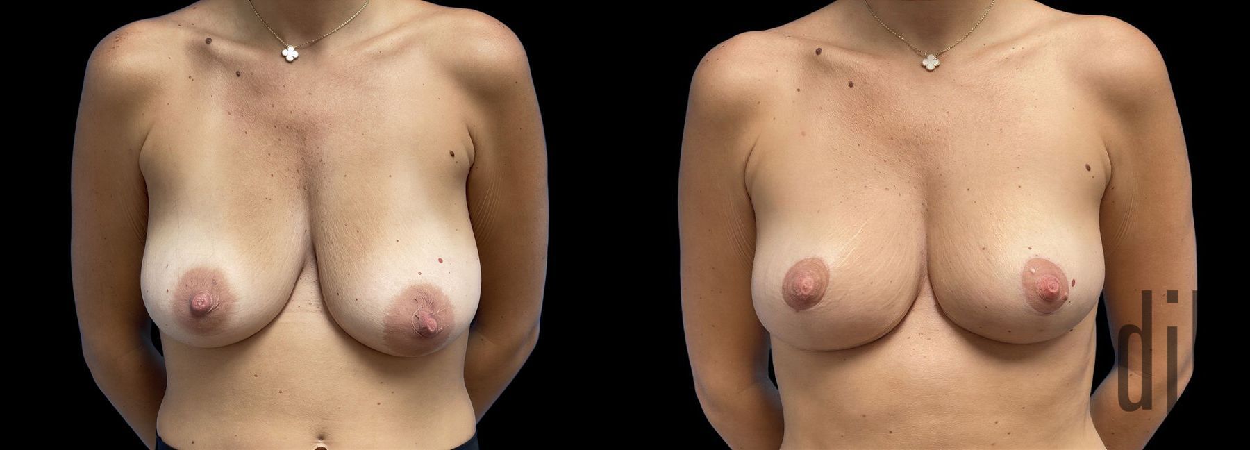 Before and after Breast Lift case 42804