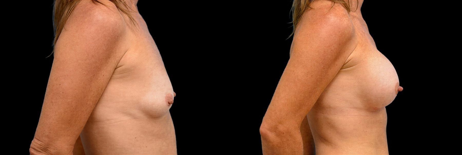 Before and after Breast Augmentation case 42818 - Angle 2