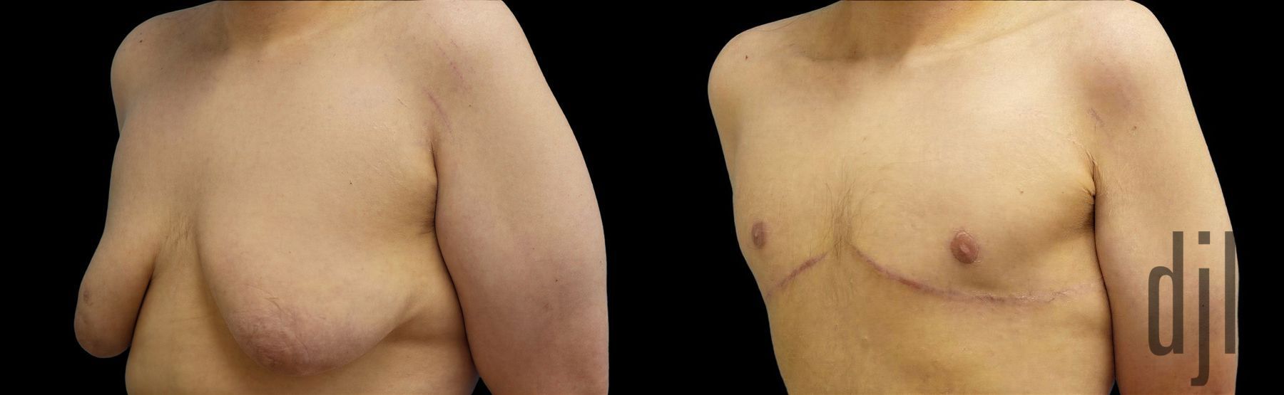 Before and after Gynecomastia case 42807 - Angle 2