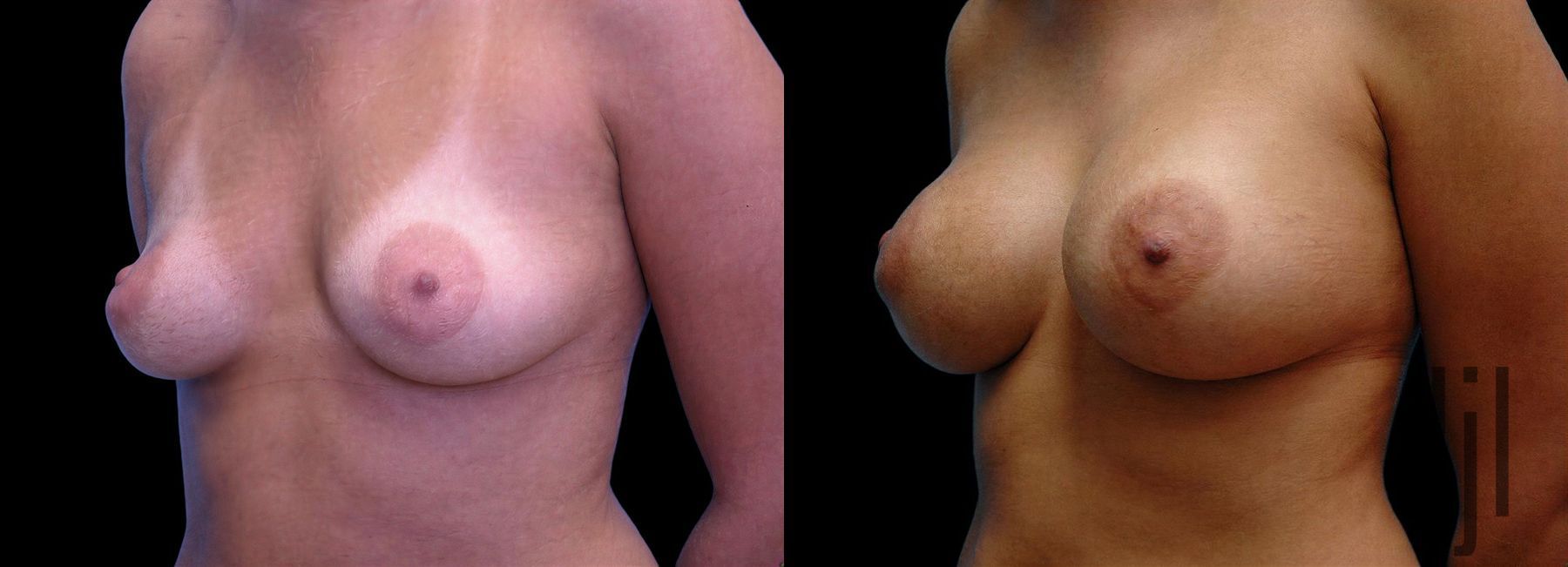 Before and after Breast Augmentation case 42602 - Angle 2