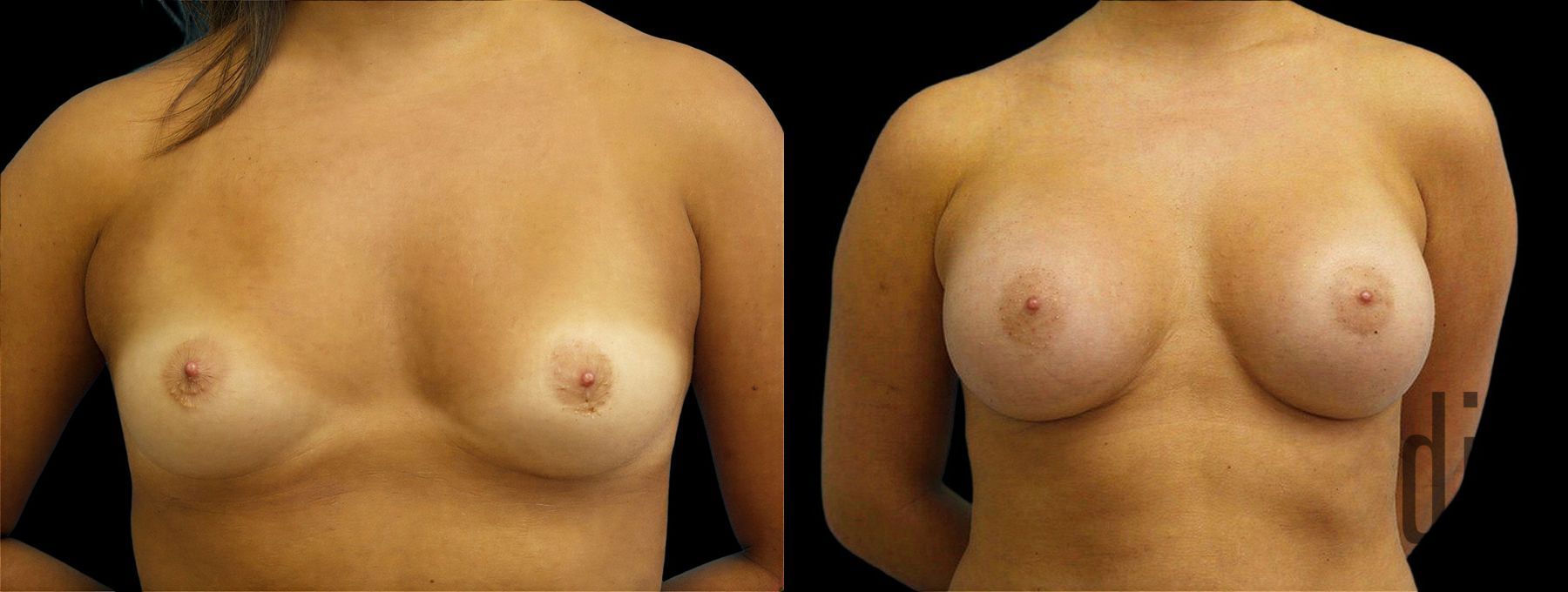 Before and after Breast Augmentation case 43000
