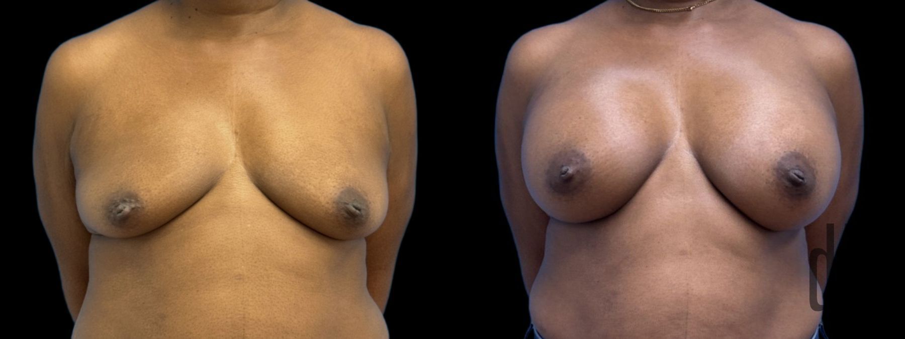 Before and after Breast Augmentation case 37382