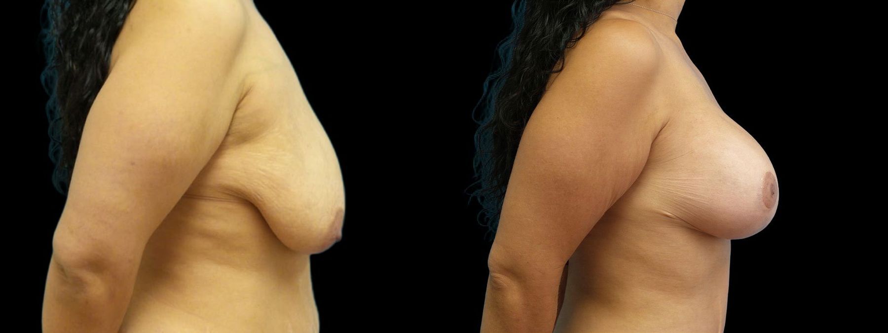 Before and after Breast Augmentation with Lift case 42948 - Angle 2
