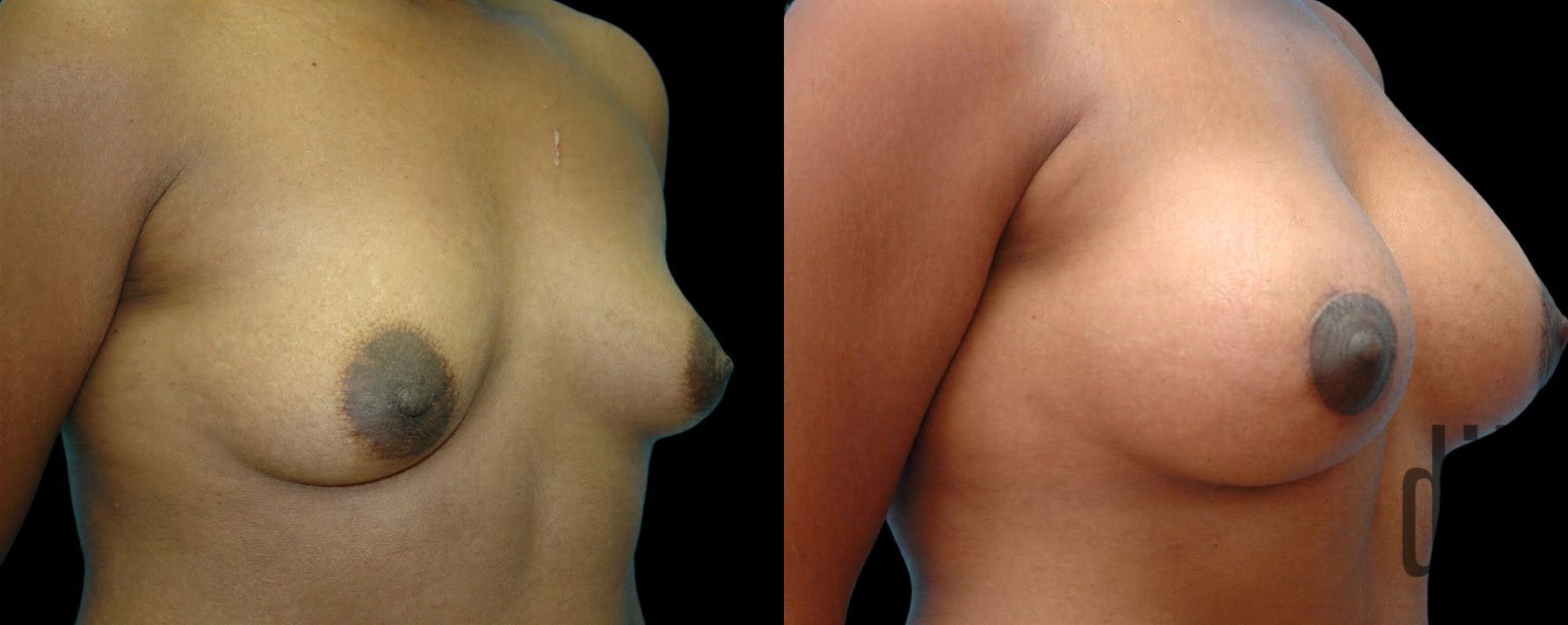 Before and after Breast Augmentation with Lift case 42638 - Angle 2