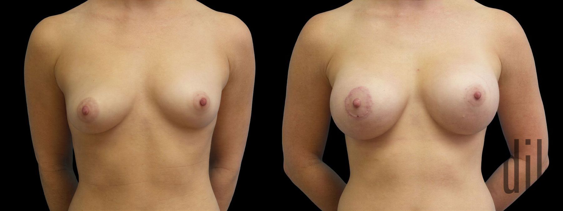 Before and after Breast Augmentation with Lift case 42942