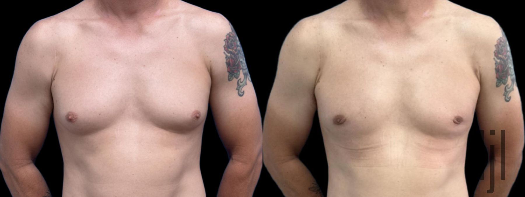 Before and after Gynecomastia case 37380