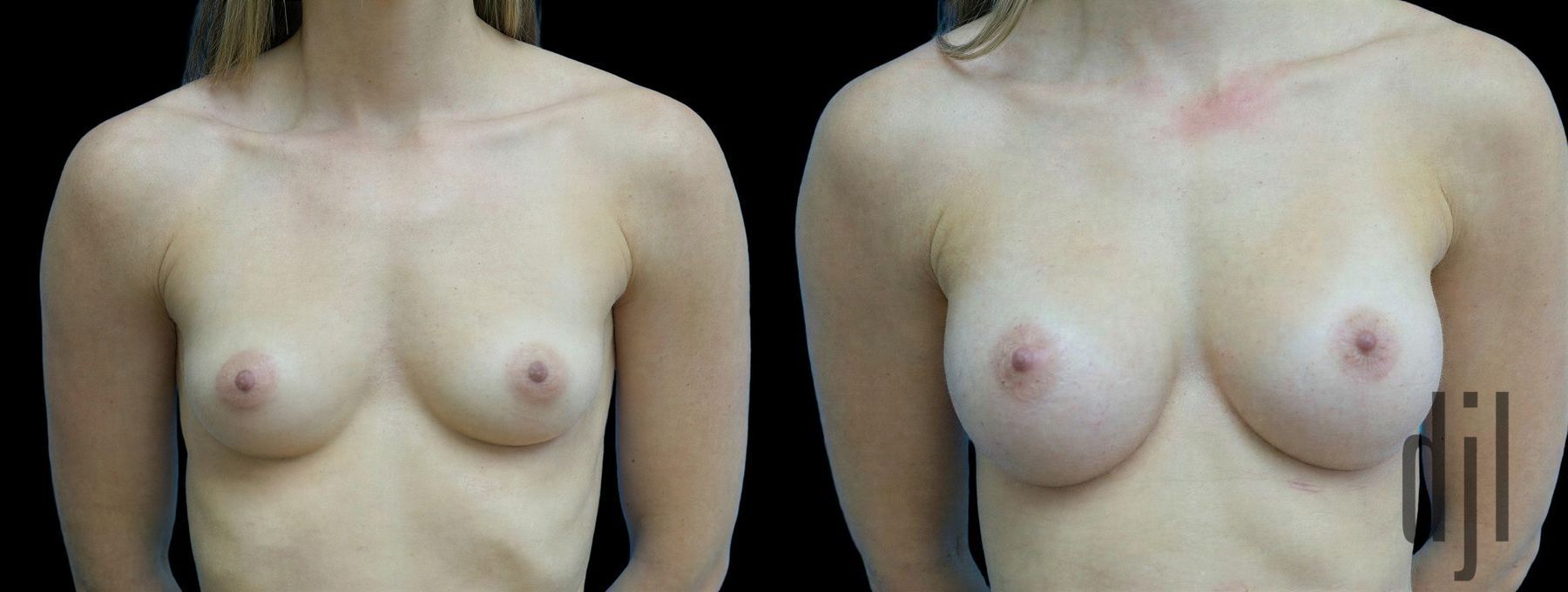 Before and after Breast Augmentation case 42944