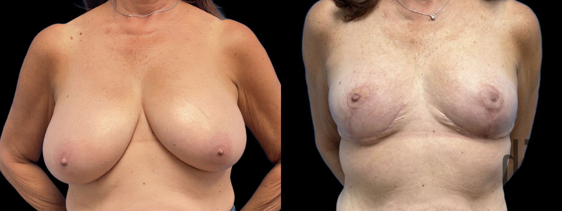 Before and after Breast Reduction case 41236