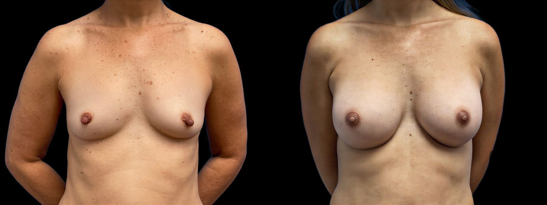 Before and after Breast Augmentation case 41239
