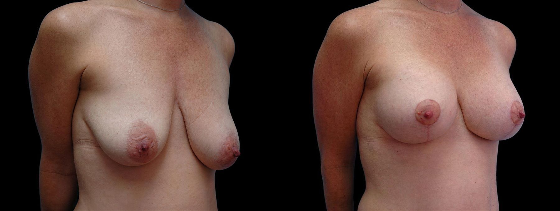 Before and after Breast Augmentation with Lift case 42545 - Angle 2