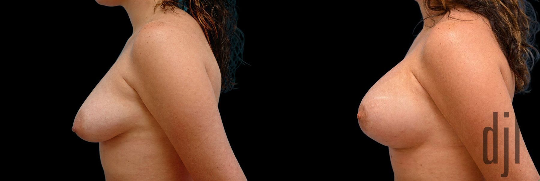 Before and after Breast Augmentation with Lift case 42725 - Angle 2