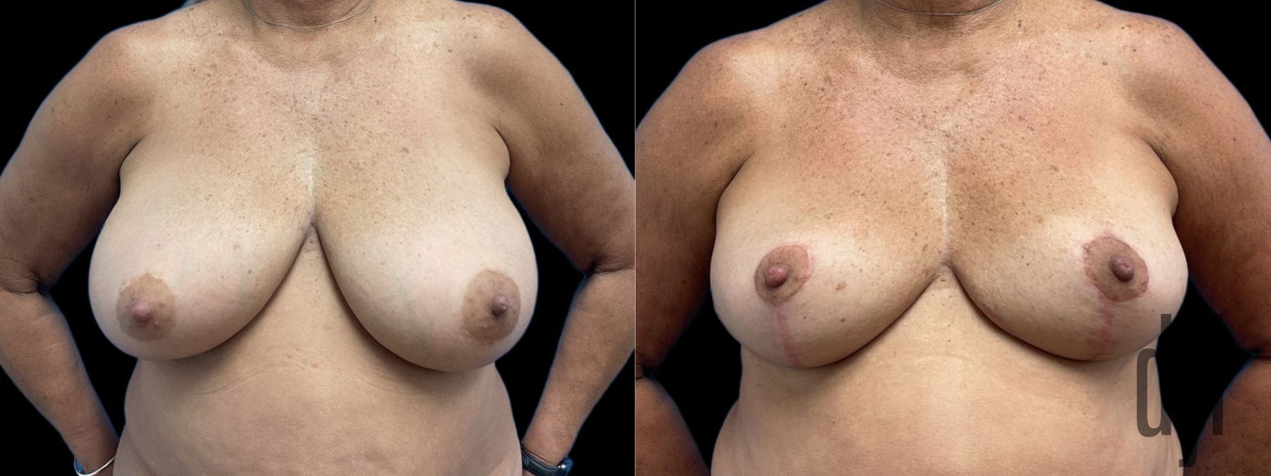 Before and after Breast Reduction case 41234