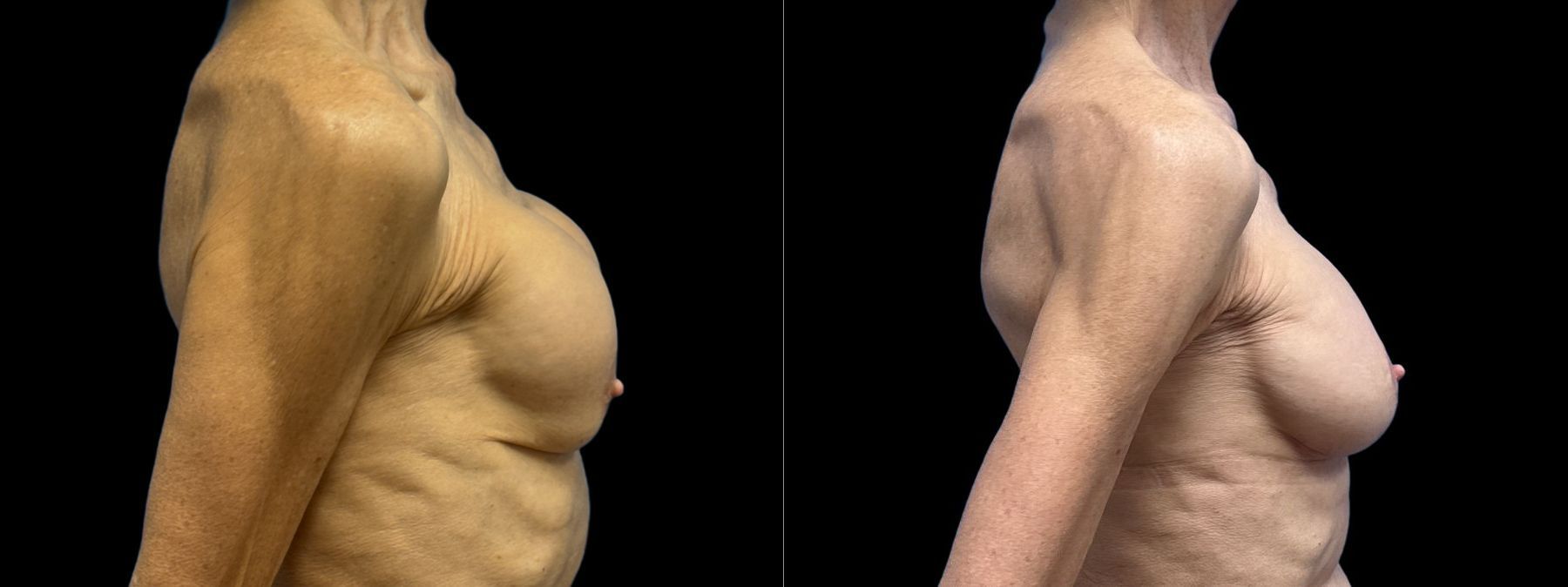 Before and after Breast Augmentation case 37376 - Angle 2