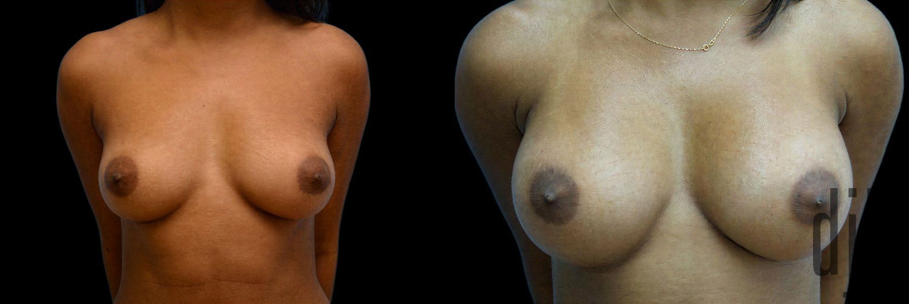Before and after Breast Augmentation case 42915
