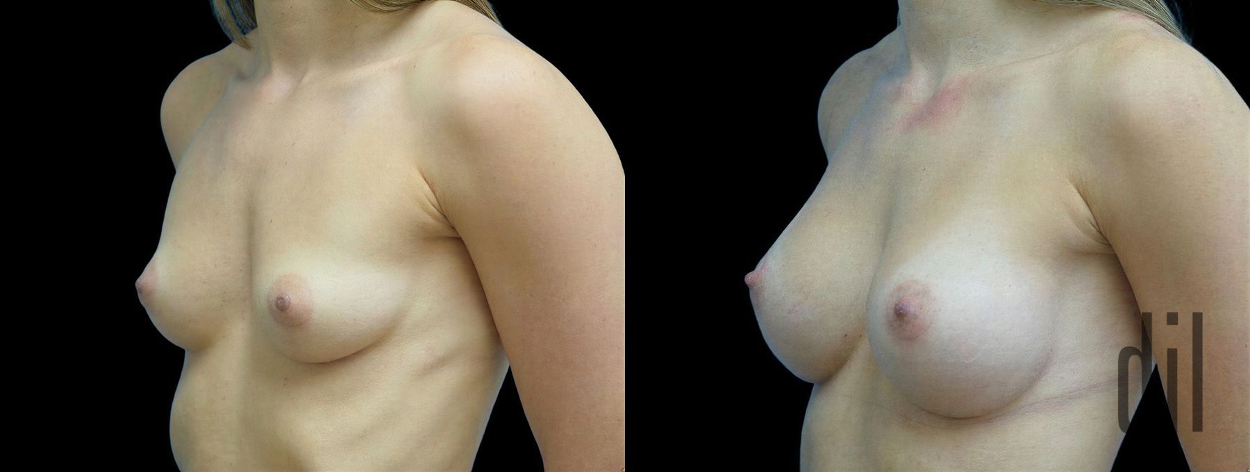 Before and after Breast Augmentation case 42944 - Angle 2
