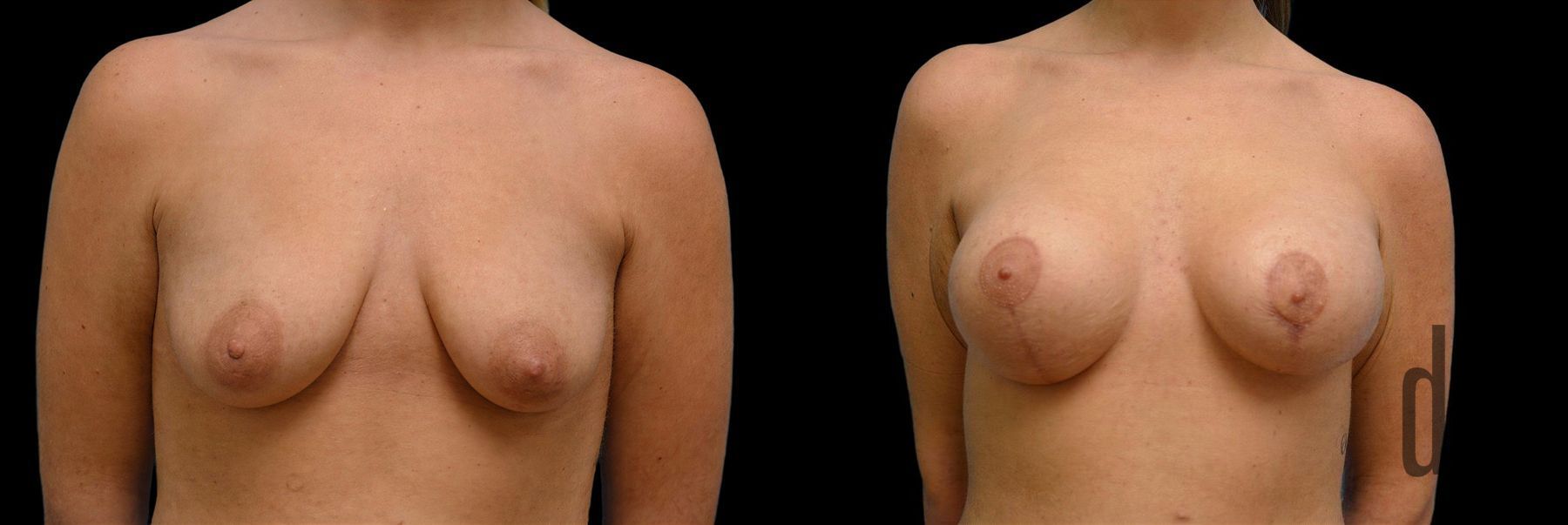 Before and after Breast Augmentation with Lift case 42769