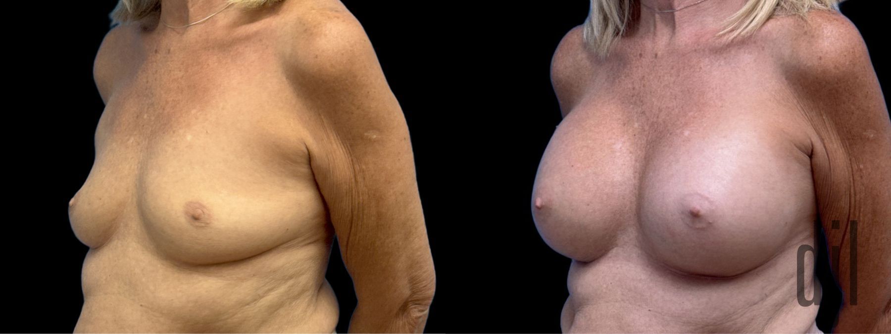 Before and after Breast Augmentation case 33058 - Angle 2