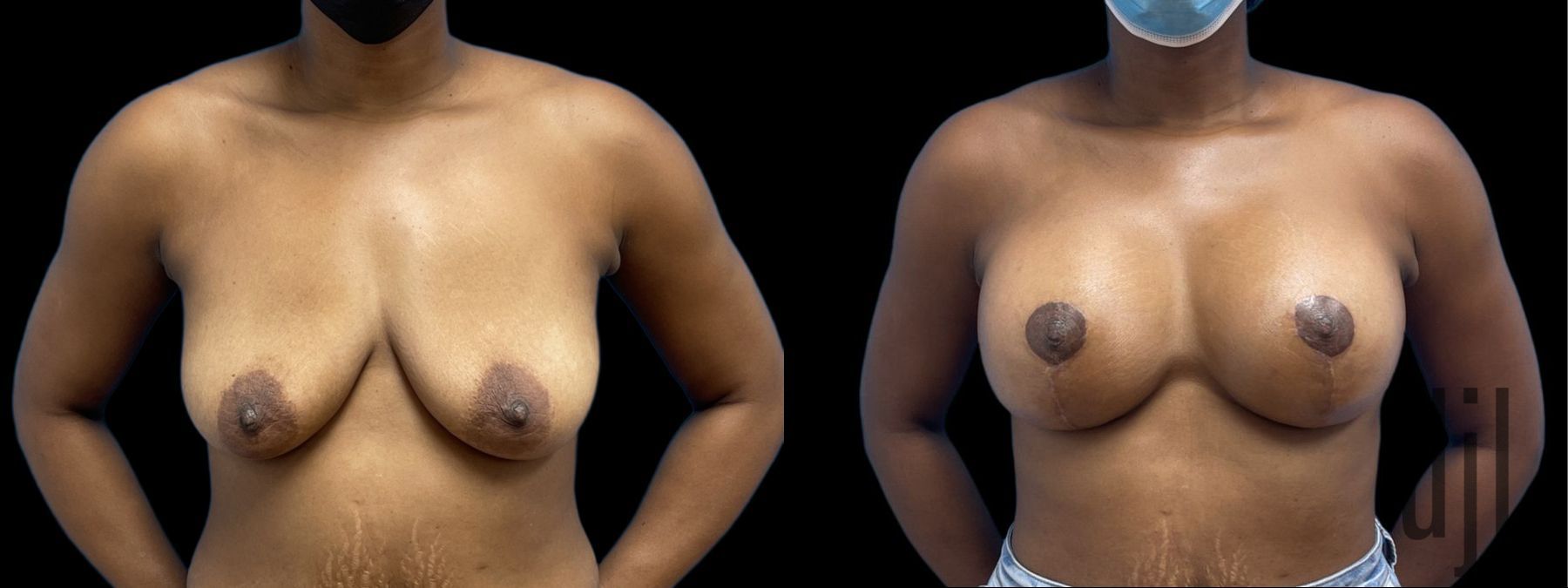 Before and after Breast Augmentation with Lift case 41231