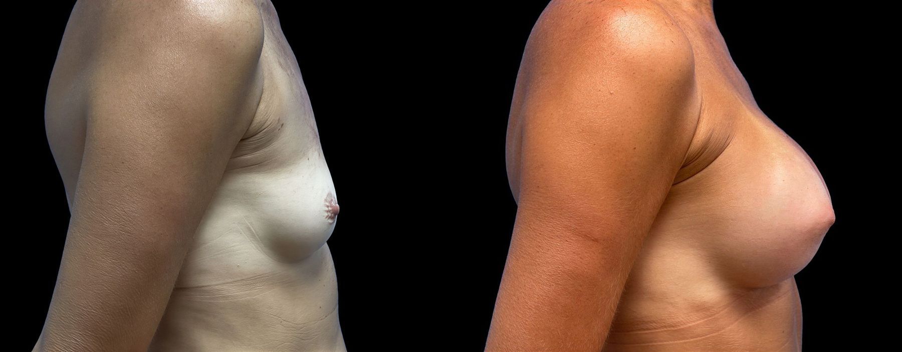 Before and after Breast Augmentation case 43035 - Angle 2
