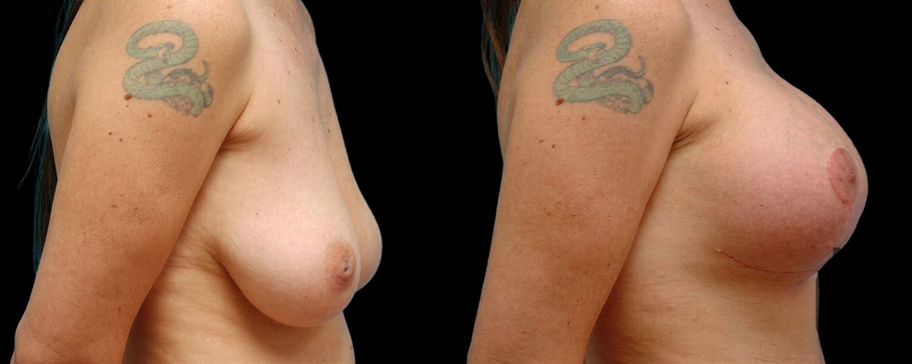 Before and after Breast Augmentation with Lift case 42689 - Angle 2