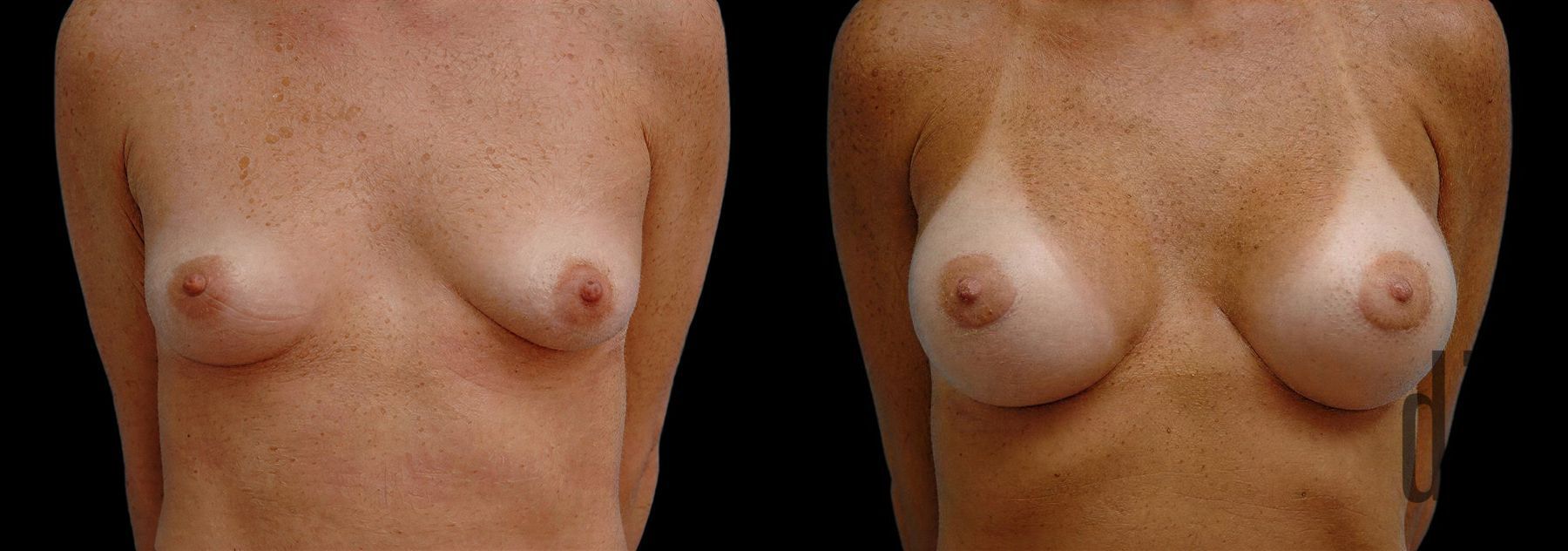 Before and after Breast Augmentation case 42554