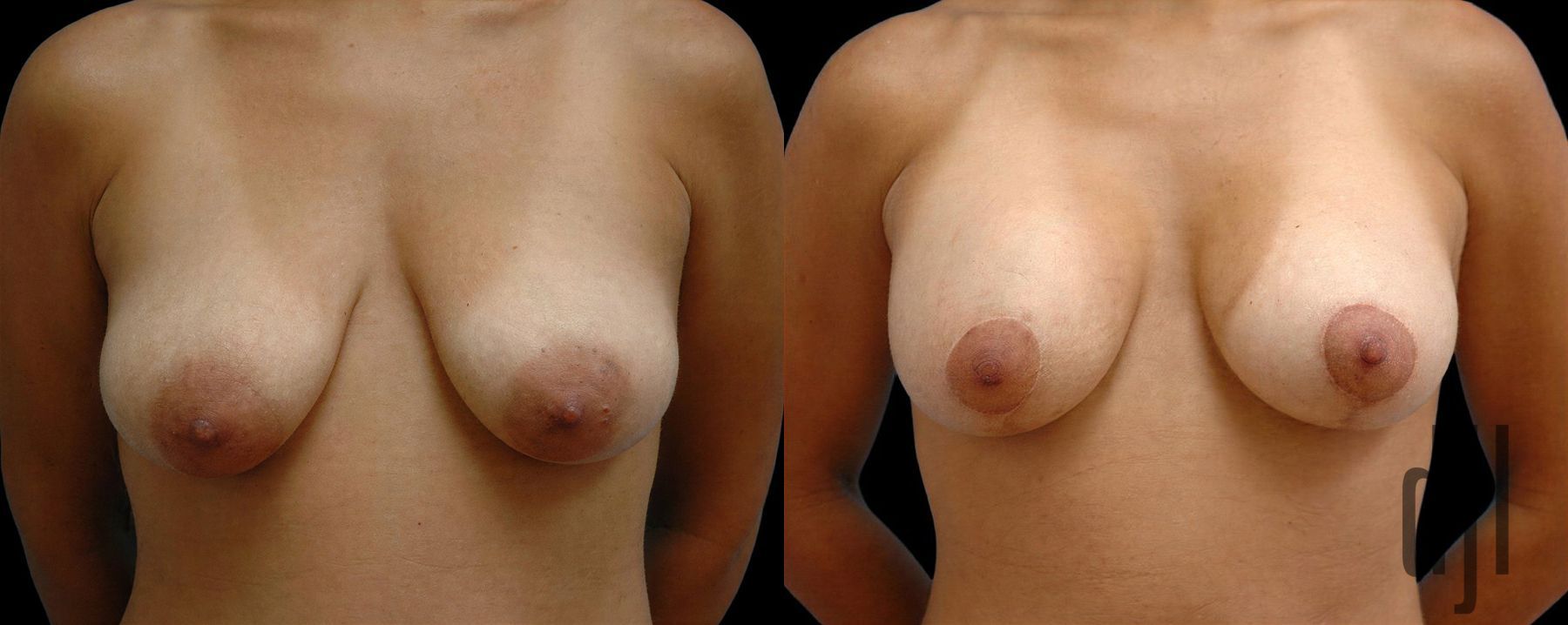 Before and after Breast Augmentation with Lift case 42600